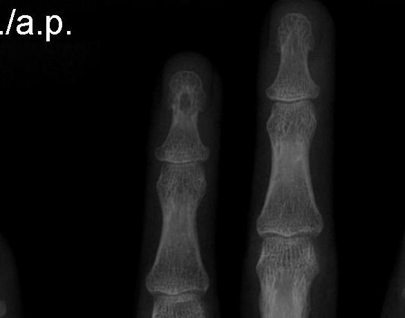 Epidermal Inclusion Cyst